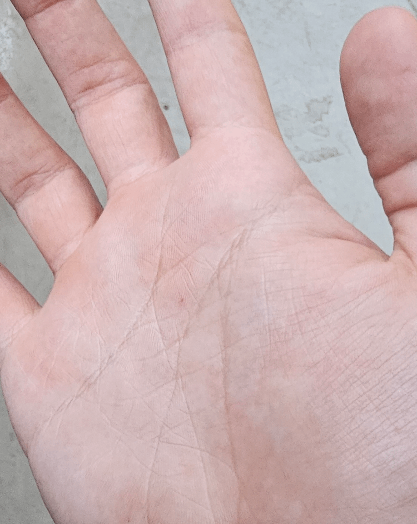 this-little-red-spot-on-my-palm-since-i-was-14-i-cant-get-rid-of-it